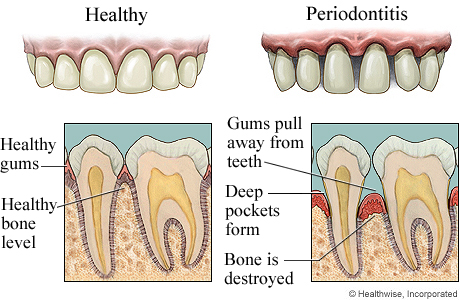 What are the symptoms of periodontal gum disease?