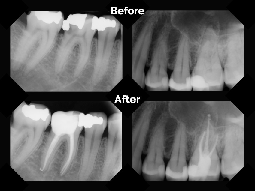 Root Canal Molar Before And After
