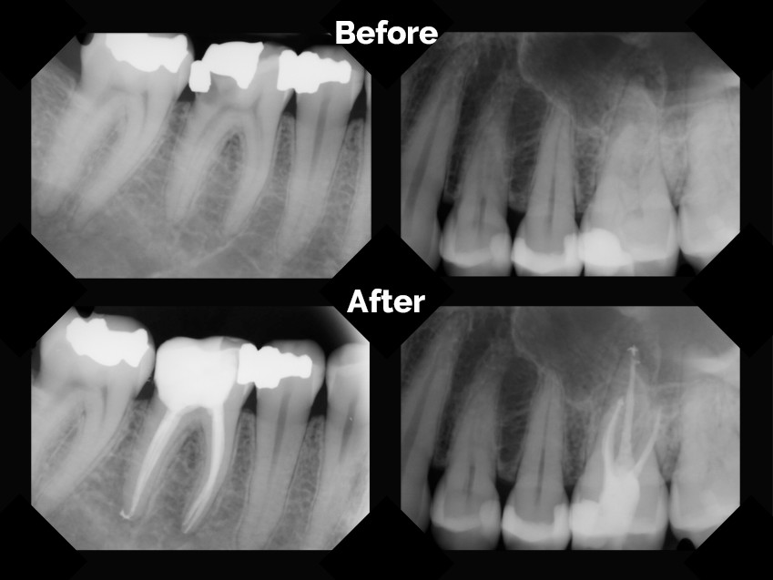 Root Canal Molar Before And After Root Canal Molar Before And After